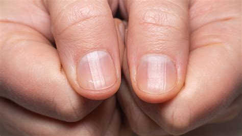 What It Really Means When Your Fingernails Won't Grow