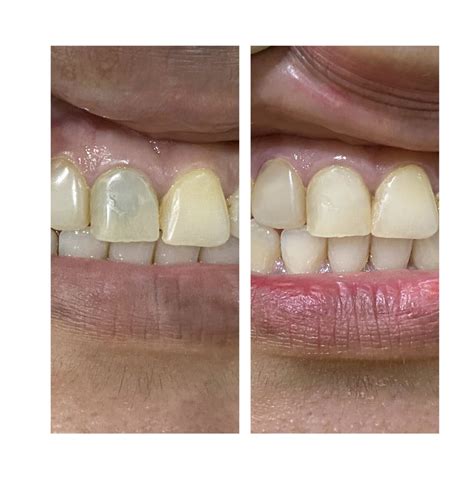 Internal bleaching for root canal treated tooth! – Dr. Debbie – Klinik Pergigian Fauziah