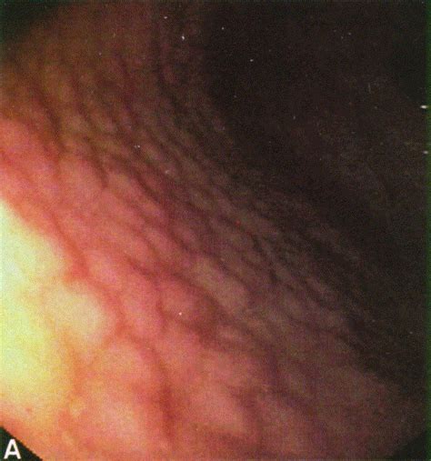 Interobserver agreement and predictive value of endoscopic findings for H. pylori and gastritis ...