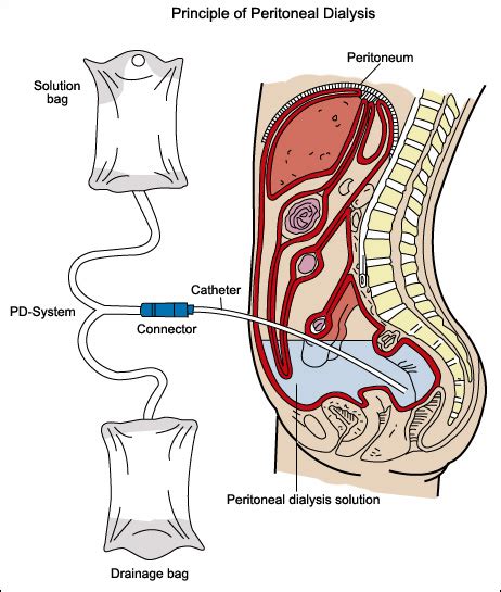 Peritoneal Dialysis - NephCure