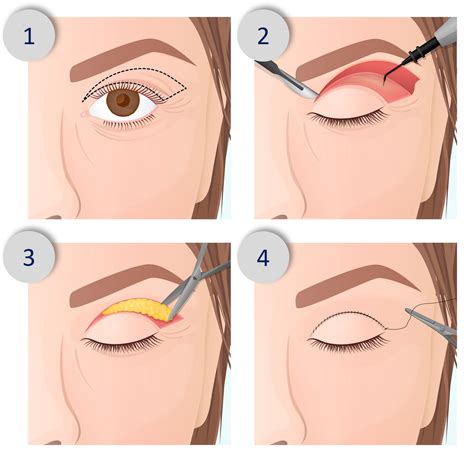 Double Eyelid Surgery In Singapore - Your Complete Guide