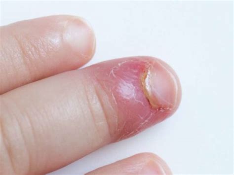 WHY DOES MY FINGERNAIL HURT ON THE SIDE? | HealthGist.Net