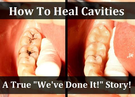 How To Heal Cavities – The Astonishing Claims Of The Oil Pullers | Non ...