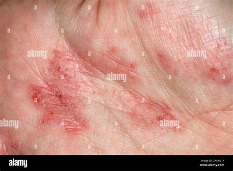 Close up of mild pompholyx, a form of eczema, on the palm of the hand a 22 year old woman. This ...