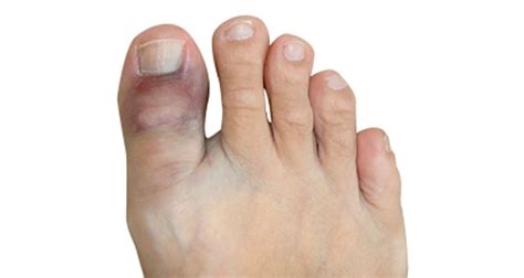 Broken Toe - Symptoms, Causes, Treatment & Rehabilitation