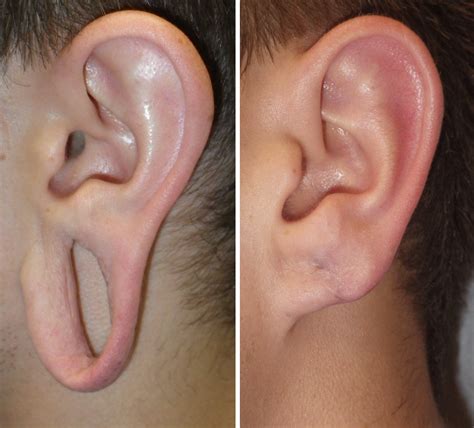 Gauged Earlobe Repair: A growing Request