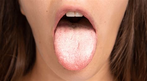 Oral candidiasis affects men and women similarly | PortalCLÍNIC