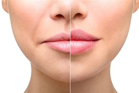 Everything That You Need to Know About Lip Lift