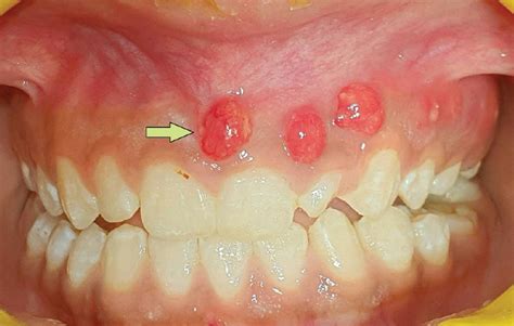 Mucormycosis Palate