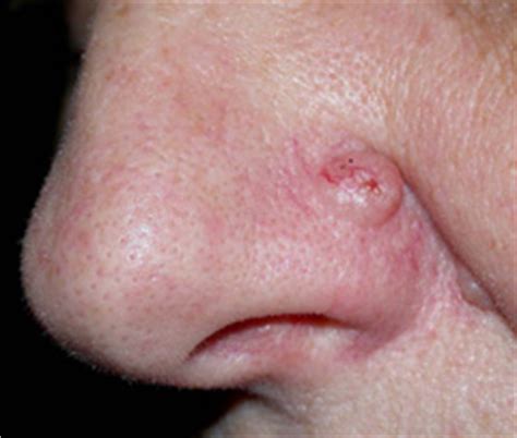 Youthful Image Clinic - Basal Cell Carcinoma