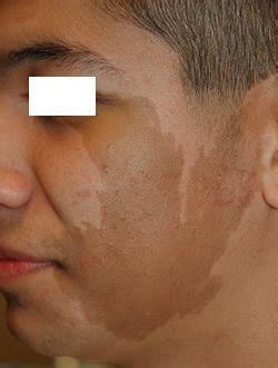 Laser Birthmark Removal Scottsdale AZ | Tempe AZ - Perfect Skin Center