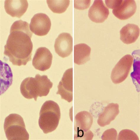 (PDF) A case of hunter syndrome and Alder-Reilly anomaly