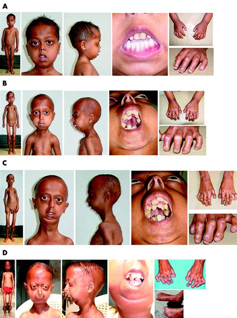 Hutchinson Gilford Progeria Syndrome