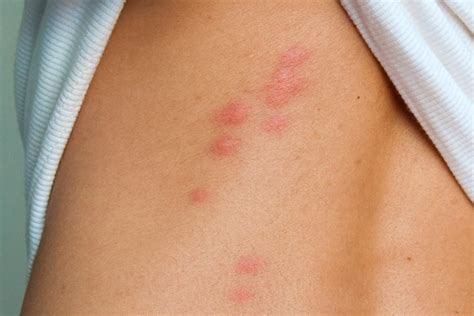 Bed Bug Bites Prevention 2 Identification