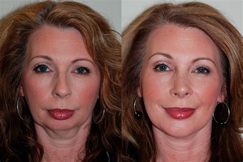 Chin Implants before and after - Artemedica