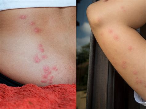 Bed Bug Bites Pictures, Symptoms: What Do Bed Bug Bites Look Like? | lupon.gov.ph