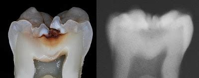 Química en Acción, El Díente: Formación y Componentes : Formación De La Caries Dental