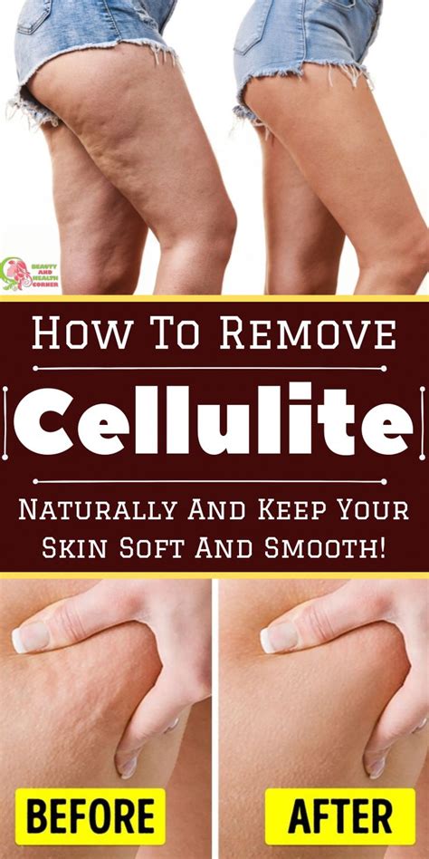 Pin on Laser Cellulite Removal