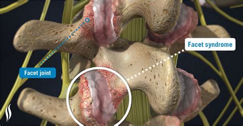 This week we will be covering Facet Syndrome which is a type of ...