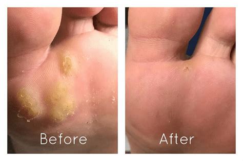 Plantar Wart Root Removal Surgery | Bruin Blog