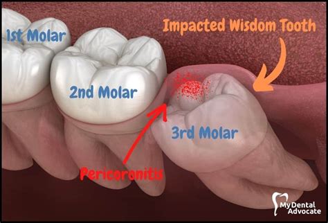 Impacted Wisdom Teeth: Symptoms, Causes, Removal & Recovery