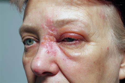 Shingles Rash Photograph by Victor De Schwanberg/science Photo Library ...