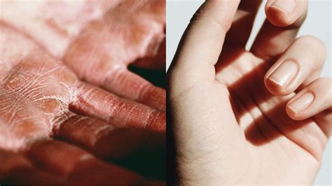 Eczema vs Scabies: Understanding the Key Differences - Health Tenfold