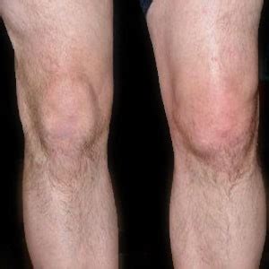 What causes gout in the knee? - proquestyamaha.web.fc2.com