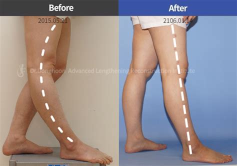 Genu Recurvatum Correction – Limb Lengthening & Complex Reconstruction Service: Korea | DALRI