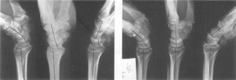 Case 6 and 25. Comparison of two similar injuries during palmar ...