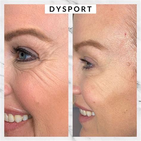 Dysport Filler Injections in Gilbert, AZ | Colair Luxury Med Spa