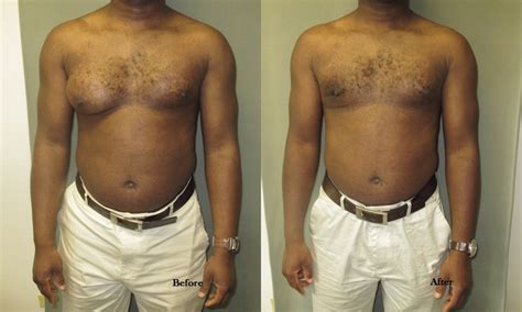 Gynecomastia - Causes, Symptoms, Diagnosis, Treatment, Surgery | Diseases Pictures