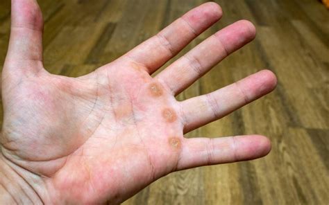 Are Guitar Calluses Bad? What You Need To Know – GuitarAdvance ...