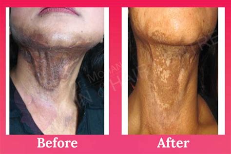 Laser Burn Scar Removal/Treatment in Phagwara, Punjab, India - Surgery Cost & Full procedure