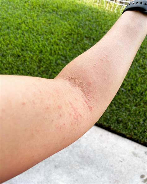 Dust Mites Allergy