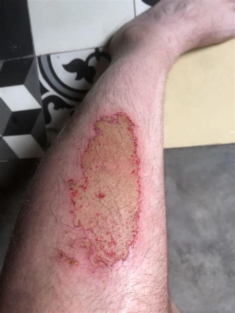 What does infected road rash look like - forlessmaha