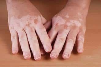 What Are Skin Pigmentation Disorders?