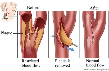 Carotid Endarterectomy | HealthLink BC