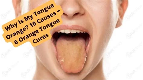 Why Is My Tongue Orange? 10 Causes + 6 Orange Tongue Cures - YouTube