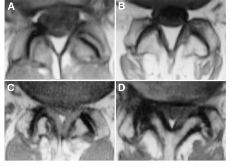 A-D Four grades of facet joint osteoarthritis on MRI (TR = 570 ms/TE =... | Download Scientific ...