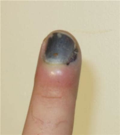 If you lose a fingernail, will it grow back? - AR15.COM