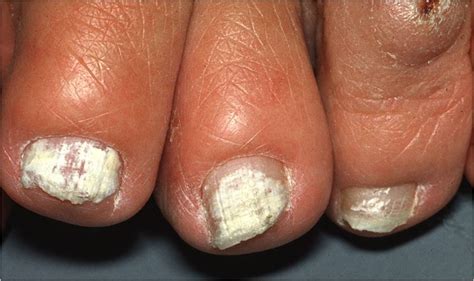 Onychomycosis (Tinea unguium, Nail fungal infection) - The Clinical Advisor