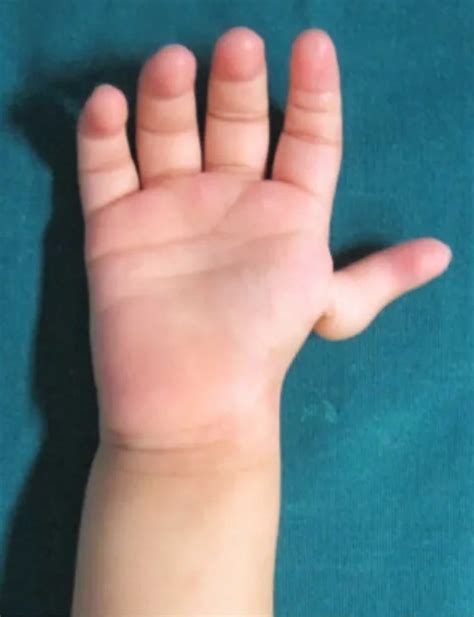 Thumb hypoplasia causes, classification, diagnosis & treatment