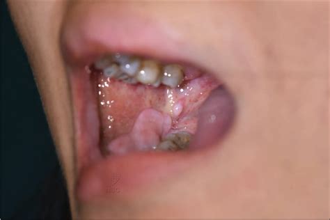 Successful treatment of a case of recalcitrant recurrent aphthous stomatitis using steroid ...