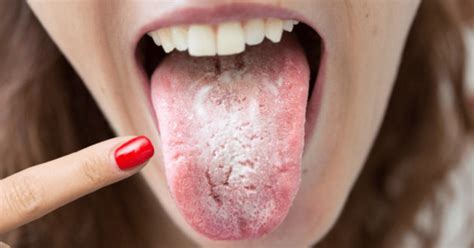 Oral Thrush - Causes Symptoms And Treatment - Apollo Hospitals Blog