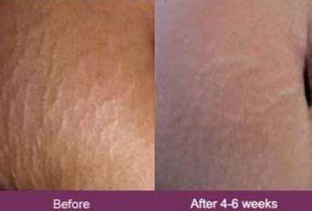 Mederma Before and After: How This Scar Treatment Changed My Life - WAY OF WILL CBD