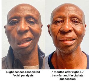 Cancer-Associated Facial Paralysis | UNC Facial Nerve Center