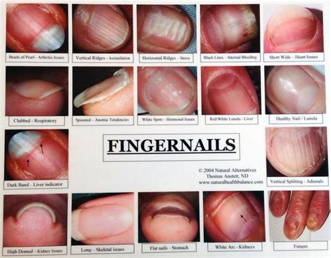 1. Fingernail with disorder | Nail health signs, Fingernail health signs, Fingernail health