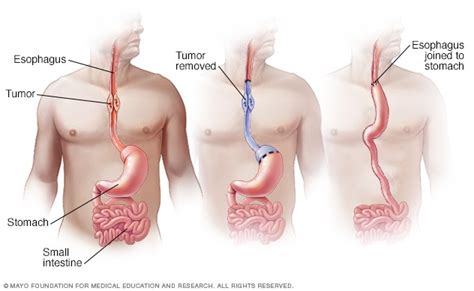 Esophageal cancer surgery - Mayo Clinic