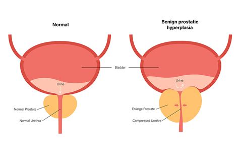 aging can affect your bladder function